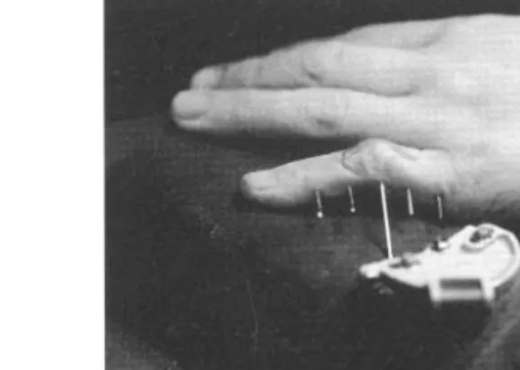 Fig . 2 . Contracted and adhesive soft tissues were released through the  dorso-lateral skin incision to increase joint motion range