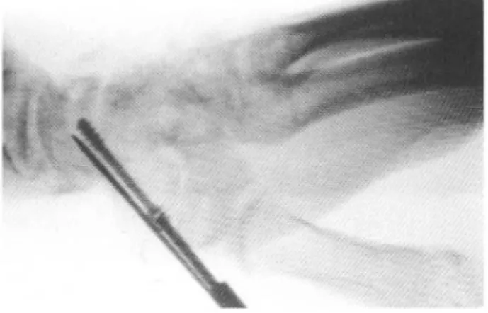 Fig . 1. A small skin incision over the scapho- scapho-trapezial joint . This showes a K- wire and Herbert screw fixation.