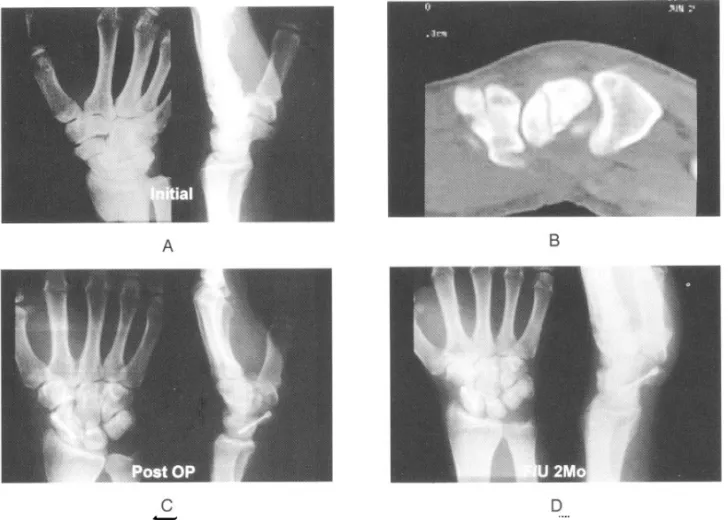 Fig . 4 . A. The Wrist of a 30 years old laborer. A waist scaphoid stable fracture was diagnosed.