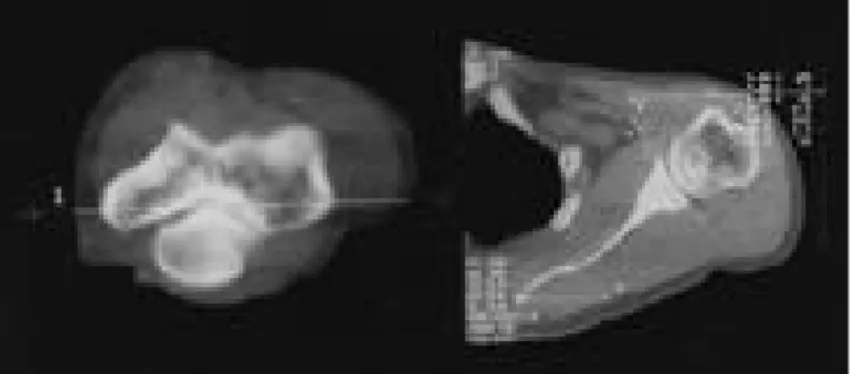 Fig. 4. Glenoid retroversion are variable at different level and decreased at the lower scan.