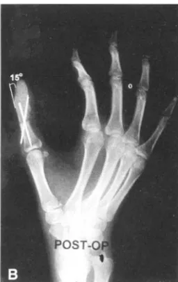 Fig . 2- A . Female 25 years old patient. The thumb was amputated at interphalangeal joint level.