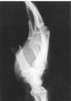 Fig . 1- D . On the oblique projection is a dorsal hamate rim fracture and is a fracture fragment between the bases of the fourth  meta-carpal and hamate.