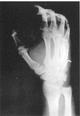 Fig . 3- A . Anteroposterior view show- show-ing overlappshow-ing of the fourth and fifth metacarpal bone with hamate