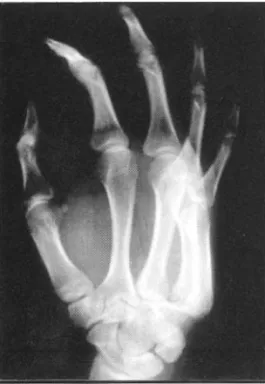 Fig . 4- A , B . Anteroposterior and lateral view after closed reduction showing well reduced and clear joint space between the bases of the  metacar-pals and the carpus, with parallel joint surfaces.