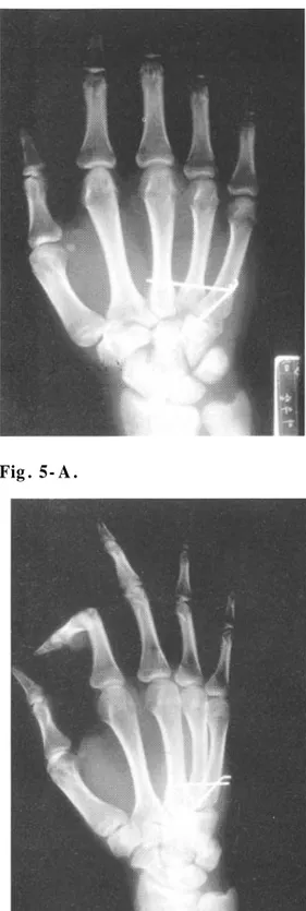 Fig . 5- A , B . On the anteroposterior and oblique view after closed reduction and percutaneous pinning of the metacarpal bases with Kirschner wires showing good reduction and normal anatomic configuration of carpometacarpal joints.