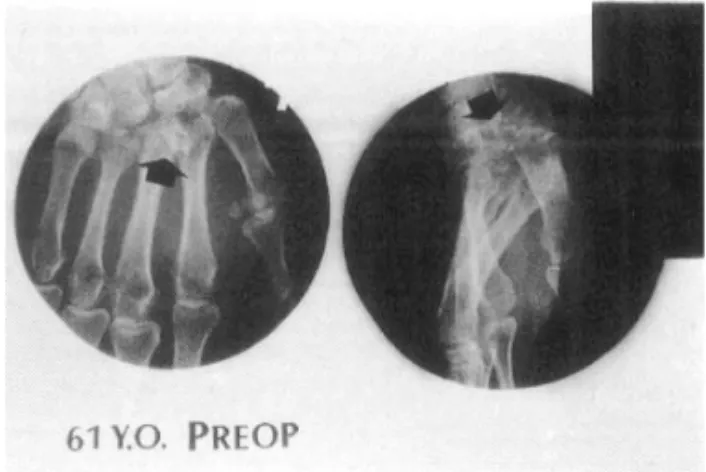 Fig . 1. The initial radiographs of 61- year- old male with total carpometacarpal dislocations.