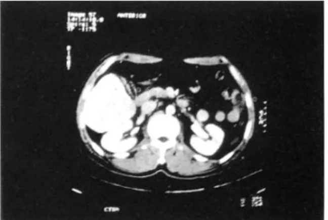 Fig . 1. A CT scan of abdomen shows a huge mass in the inferior segment of right lobe of the liver.