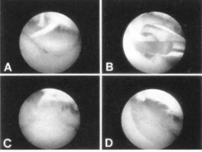 Fig . 2A - D . Arthroscopic findings of TFCC tear.