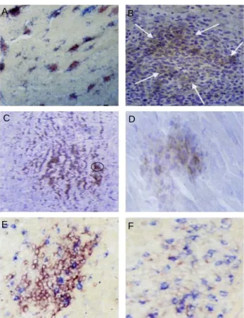 Fig. 6. Immunohistology of developing MD lymphomas, all coun- coun-terstained with haematoxylin and eosin