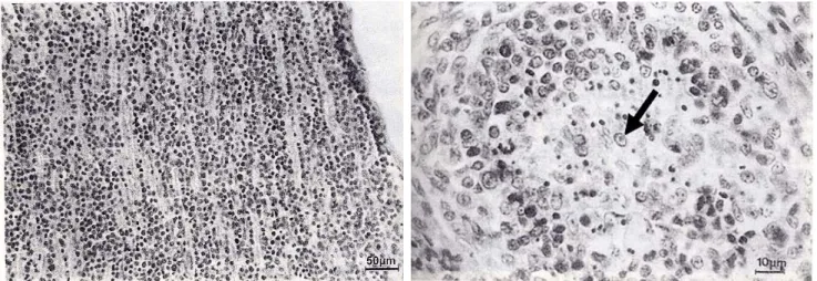 Fig. 6. MD pathogenesis induced by infection of virulent MDV. A, Nerve lesion, 5 weeks after infection of a 1-day-old chick with vMDV