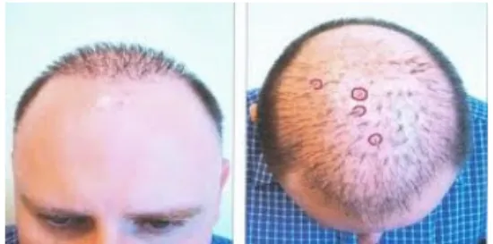 Fig.  1. Ham is taken even what is usually just a  ham.[37,38] 다음,  서울중앙지법  2007가합16095의  경우는  성형외 과  병원  홈페이지에  게시한  모발이식  전후의  환자  사진 과  온라인  상담내용은  모두  작성자의  개성이나  창조성이  있다고  보기  어려워  저작물성이  인정되지  않으나,  다른  성형외과  원장이  이를  무단으로  도용해  자신의  홈페이지 에  게시한  것은