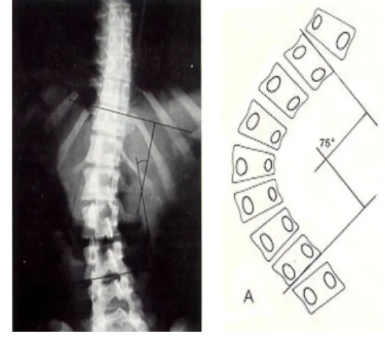 Fig. 1. Cobb's angle 2.4 복부근지구력측정 복부근지구력은  대상자가  바닥에  누운  상태에서  보조 자가  다리를  고정하여  무릎을  직각으로  구부린  후,  상체 를  일으켜  팔꿈치가  무릎에  닿고  다시  누운  상태로  되돌 아가면  1회로  간주하여  그  횟수를  30초간  측정하였다