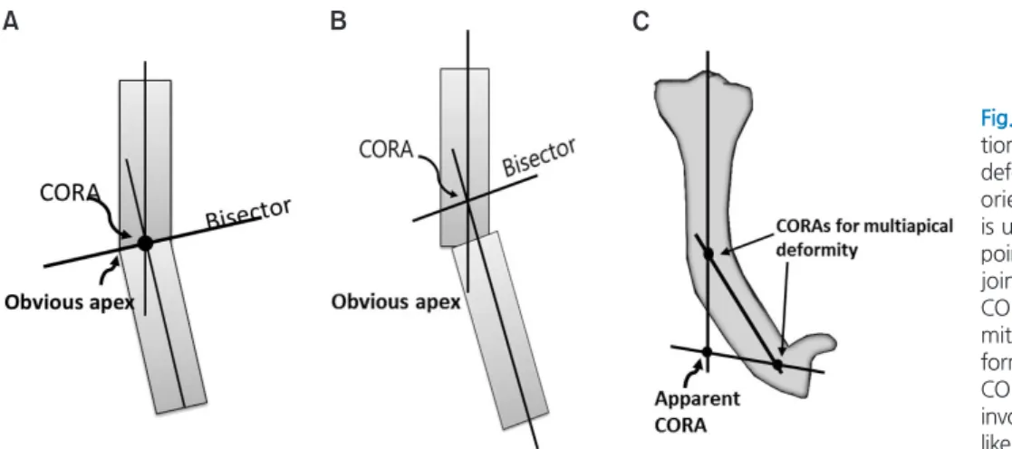 Fig. 5. (A) If center of rotation of angula- angula-tion (CORA) lies at the point of obvious  deformity apex in the bone and the joint  orientations are normal, the deformity  is uniapical