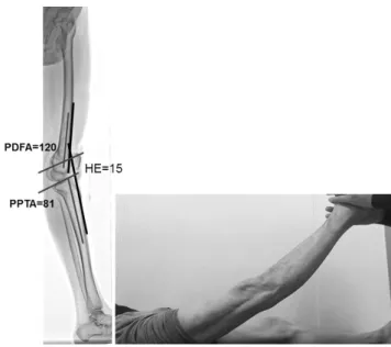 Fig. 7. The standing lateral full length radiography of lower extremity  shows 15 o  of hyperextension (HE) of the knee joint and 120 o  of PDFA,  which is 36 o  recurvatum of the distal femur