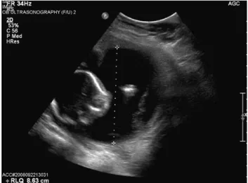 Fig  1.  Transventricular  sonographic  view  shows  fetal  choroid plexus cysts (indicated by arrows) and an  angu-lated “strawberry-shaped” skull.