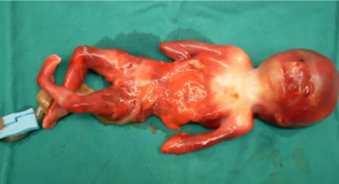 Fig  4.  Gross  appearance  after  termination.  This  image  shows the characteristic hand position of severe.