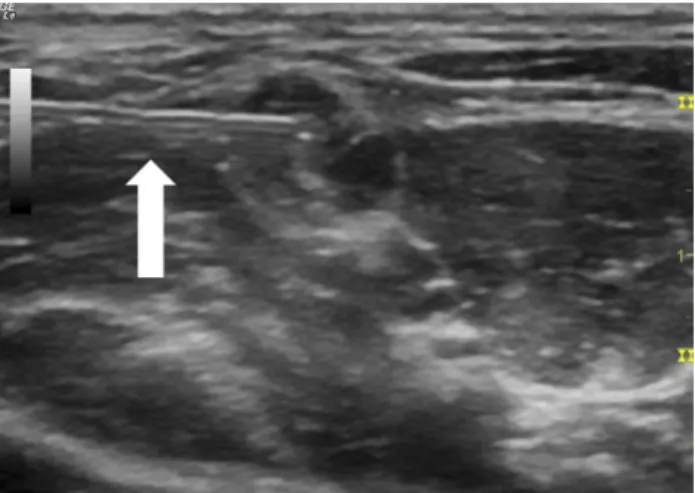 Fig.  1.  Ultrasound  image  of  interscalene  nerve  block. 