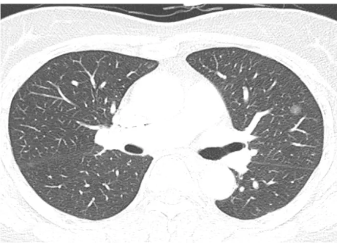 Fig. 1. Axial CT image of a ground glass nodule. CT image shows a 10 mm sized ground glass nodule in anterior segment of left upper lobe
