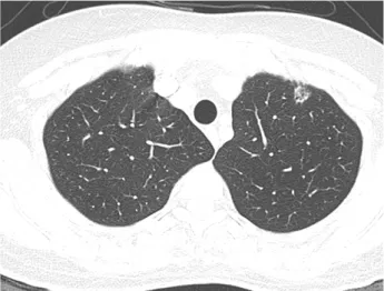 Table 1. Pathologic diagnosis according to nodular patterns Pattern of nodule