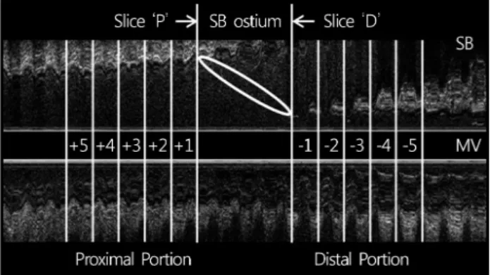 Fig. 1. Schematic representation of study segments within the  proximal and distal portions in a bifurcation lesion