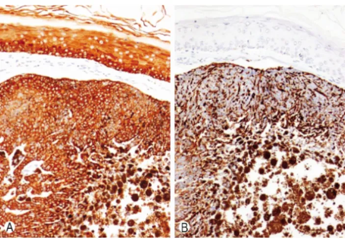 Fig. 3. Tumor cells are diffusely and strongly positive for cytoke-r atin 5/6 (CK5/6) similar to the normal epidermis (A), and are also diffusely and strongly positive for Human Melanoma Black-45 (HMB-45), a marker for melanoma (×200) (B).