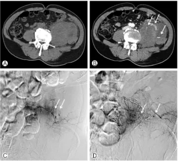 Fig. 1. Initial APCT scan showed extensive left psoas hemorrha-  gic muscular swelling with adjacent retroperitoneal hematoma  (A) and multifocal bizarre bleeding foci (B, arrows)