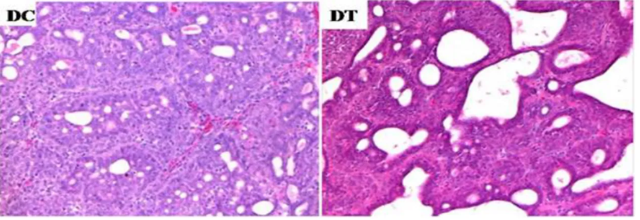 Table 2. Effect of turmeric ethanol extract on histological grade of tumors based on tubule formation, nuclear pleomorphism or mitotic rate