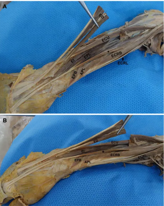Fig. 1. Variations of the extensor muscles in right forearm. (A) Superior view. (B) Lateral view