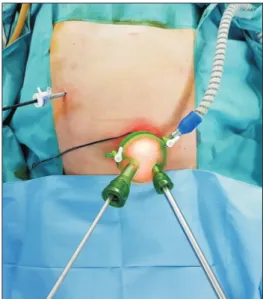 Fig. 2. It shows trocar (umbilical multichannel port + 5-mm  trocar) insertion in dual-port laparoscopic distal gastrectomy