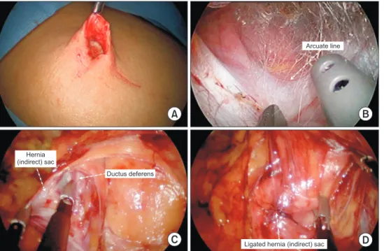 Fig. 1. Procedures for single  incision laparoscopic totally  extraperitoneal hernia repair