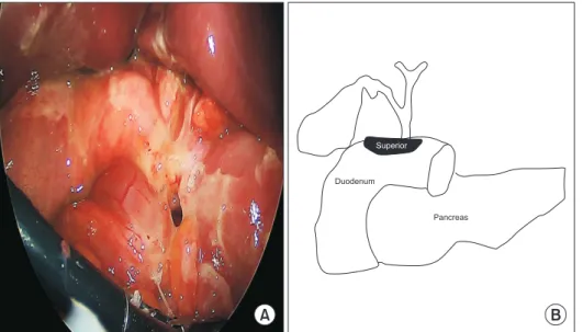 Fig. 1. Ulcer perforation on the  superior side of the duodenum. 