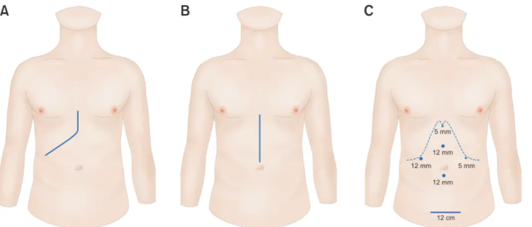 Fig. 1. Three surgical techniques  for living donor hepatectomy. 