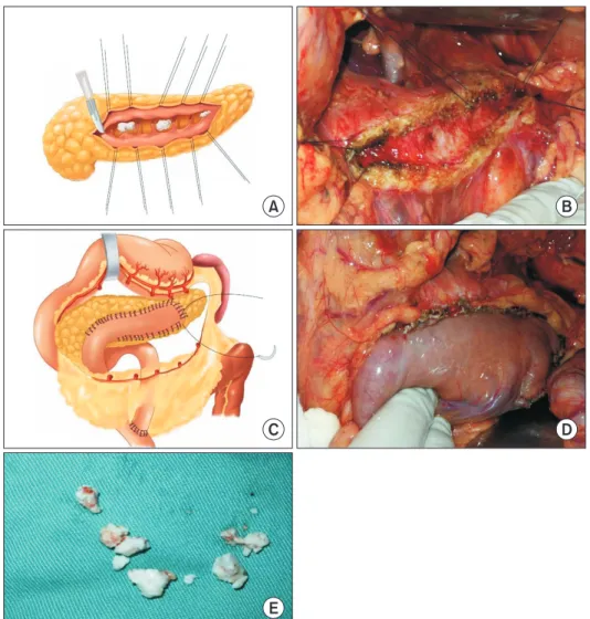 Fig. 2. Schematic diagram of the  Partington surgery. (A, B) After  longitudinal dissection of the  pancreatic duct, scattered white  calcified stones and pancreatic  tissue fibrosis in the pancreatic  duct were found