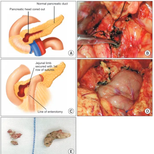 Fig. 3. Schematic diagram of  Frey surgery. (A, B) The head  of the pancreas was open and  the stones were removed for  decompression