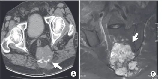 Fig. 1. (A) CT shows soft-tissue  (white arrow) mass with an  ap-proximately 8.5 × 7.0-cm axial  diameter destructing the sacrum,  containing coarse calcifications