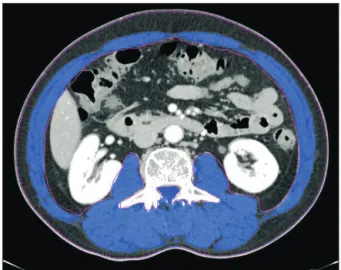 Fig. 1. Measurement of the subcutaneous and visceral adipo- adipo-sity. Axial computed tomography obtained at the level of  the third lumbar vertebra showing the region colored blue  represent the subcutaneous fat area and green represented  the visceral f