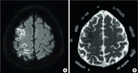 Fig. 1. The brain magnetic resonance imaging shows diffuse high signal intensity in right frontoparietal cortices  (including primary motor/sensory cortices) on diffusion weighted imaging (A) with low signals on apparent  diffusion coefficient map (B).