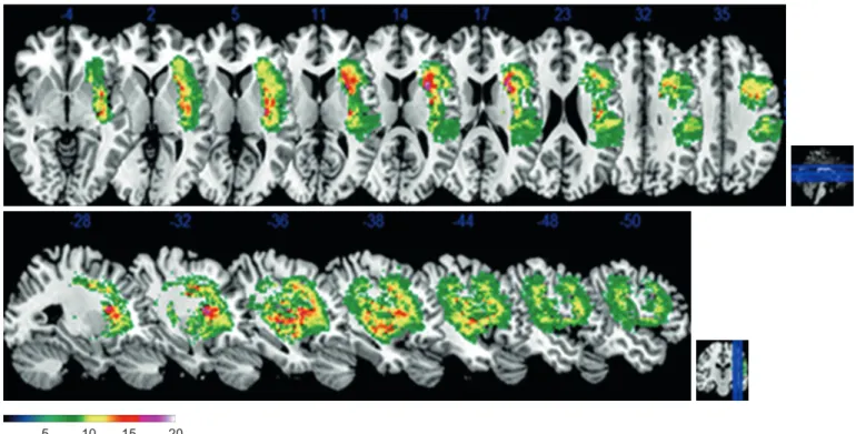 Fig. 1. Group comparison analysis between aphasia and non-aphasia group. The color bar indicates chi square (χ 2 ) by p < 0.01