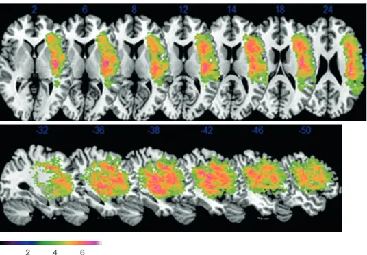 Fig. 2. Voxel-based lesion-symptom maps of significant correlation between lesion and aphasia quotient (p< 0.001 with corrected false discovery rate)