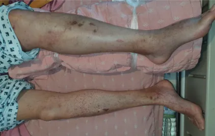 Fig. 1. Petechial rashes on both lower extremities and left lower extremity swelling due to deep vein thrombosis.