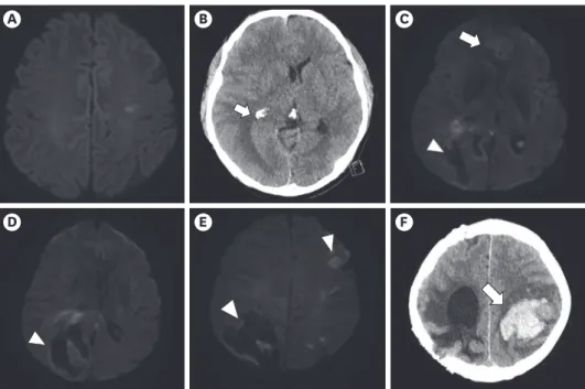 Fig. 2. A magnetic resonance imaging diffusion weighted image shows initial (December 2019) left middle  cerebral artery infarction (A) and left temporal lobe infarction with hemorrhagic transformation (B)