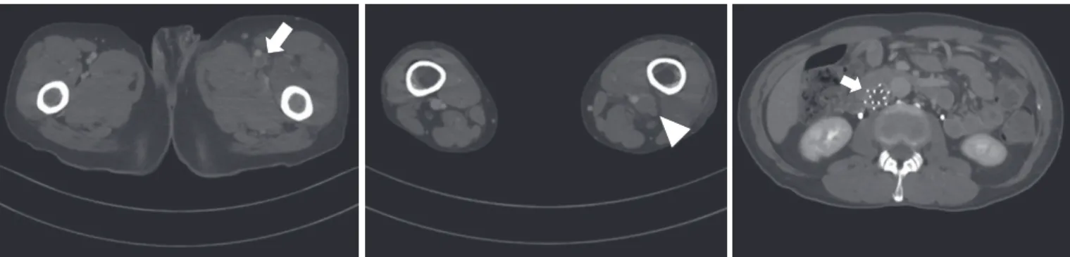 Fig. 3. Lower extremity computed tomography venography showing extensive thromboses at the left iliac, femoral (arrow on the left), popliteal veins  (arrowhead), and inferior vena cava filter inserted (arrow on the right).