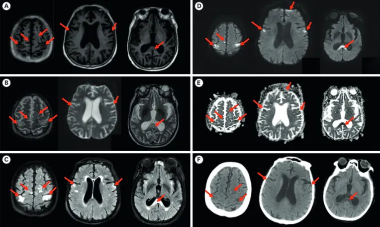 Fig. 2. Axial images of brain MRI and CT when MBD was diagnosed. MRI showed hypointensities in T1WI (A), hyperintensities in T2WI (B) and hyperintensities in  T2 FLAIR (C) in the body, splenium of corpus callosum, both precentral gyrus and both frontal cor