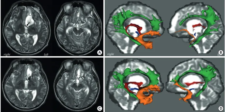 Fig. 3. Magnetic resonance images and DTT obtained 1 month (A, B) and 3 months (C, D) after the postoperative hemorrhage