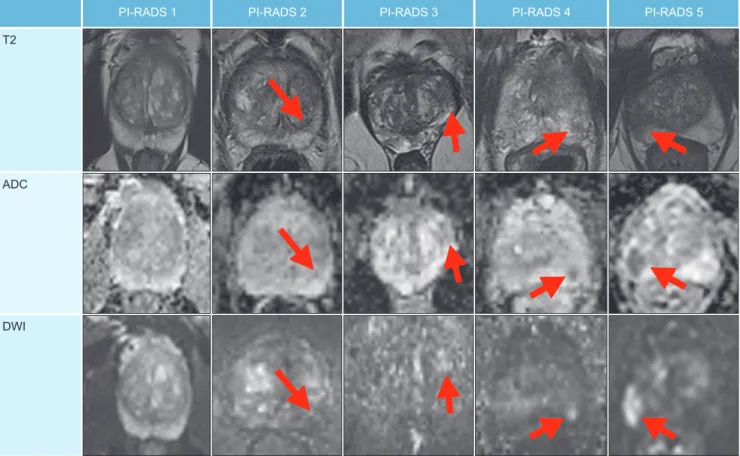 Fig. 1. Examples of lesions (marked by the arrows) graded Prostate Imaging-Reporting and Data System (PI-RADS) 1 to 5 according to PI-RADS  version 2.1