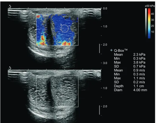 Fig. 2. Shear-wave elastography of a  56-year-old man with a penile rigidity  score of 75