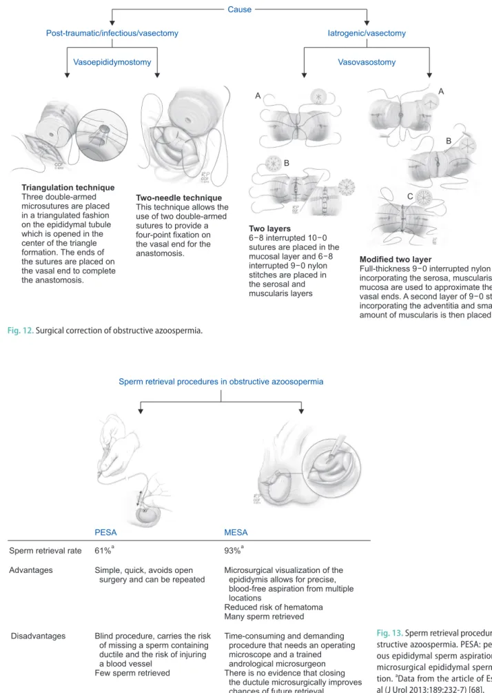 Fig. 13. Sperm retrieval procedures in ob- ob-structive azoospermia. PESA:  percutane-ous epididymal sperm aspiration, MESA: 