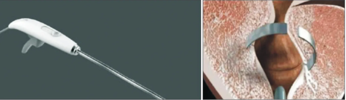 Fig. 3. Butterfly device (with permission from Butterfly Medical).