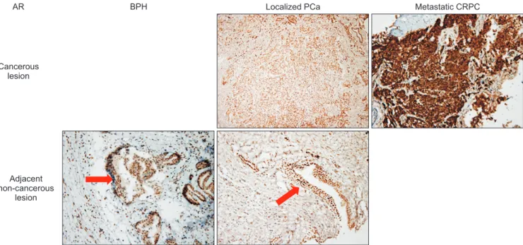 Fig. 5. Androgen receptor (AR) (brown) expression in benign prostatic hyperplasia (BPH), localized prostate cancer (PCa) and metastatic castration  resistant prostate cancer (CRPC) tissue