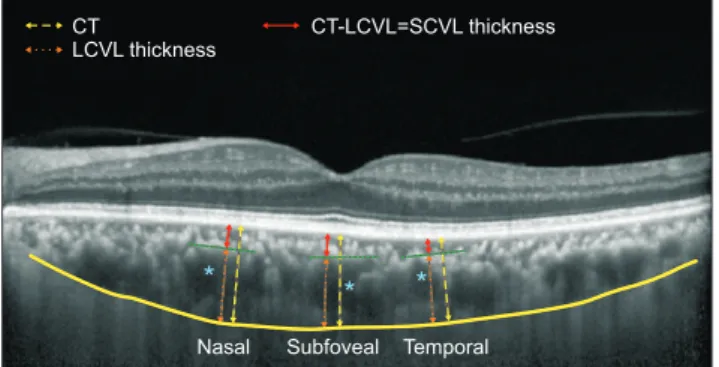 Fig. 1. Choroidal thickness (CT) measurements. CT (yellow dashed  arrows) was measured perpendicularly from the outer border of the  retinal pigment epithelium to the inner sclera (yellow line) at three  locations: at the fovea, 750 μm temporal to the fove